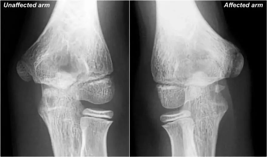 肘关节MR解剖及疾病详解 肘关节MR解剖及疾病详解