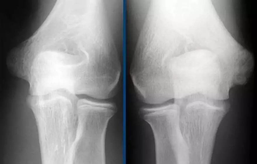 肘关节MR解剖及疾病详解 肘关节MR解剖及疾病详解