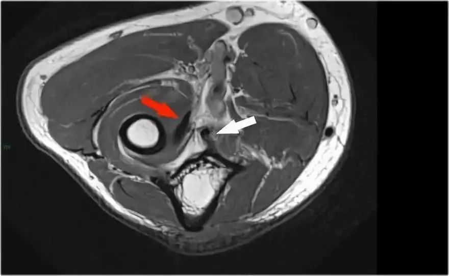 肘关节MR解剖及疾病详解 肘关节MR解剖及疾病详解