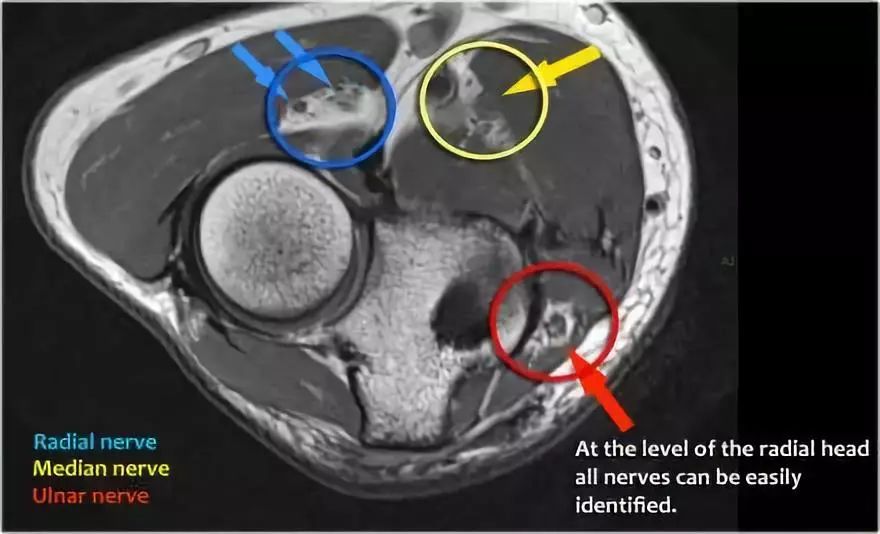 肘关节MR解剖及疾病详解 肘关节MR解剖及疾病详解