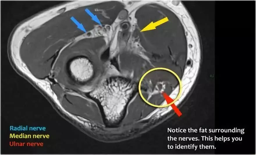 肘关节MR解剖及疾病详解 肘关节MR解剖及疾病详解