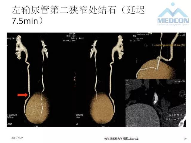 【PPT】CTU扫描方案设计和提高尿路显影的方法
