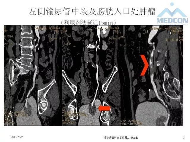 【PPT】CTU扫描方案设计和提高尿路显影的方法