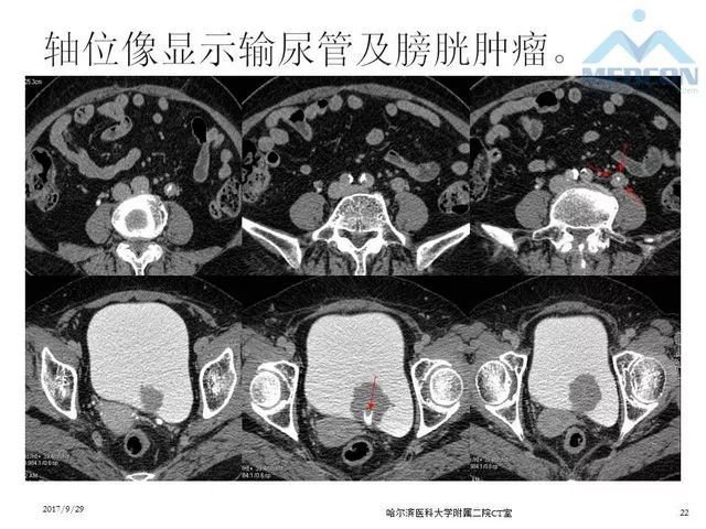 【PPT】CTU扫描方案设计和提高尿路显影的方法