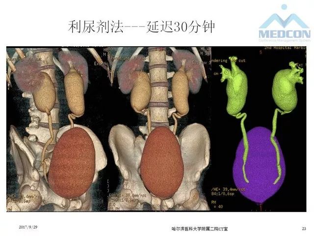 【PPT】CTU扫描方案设计和提高尿路显影的方法