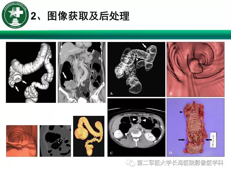 【PPT】CT结肠造影的临床应用