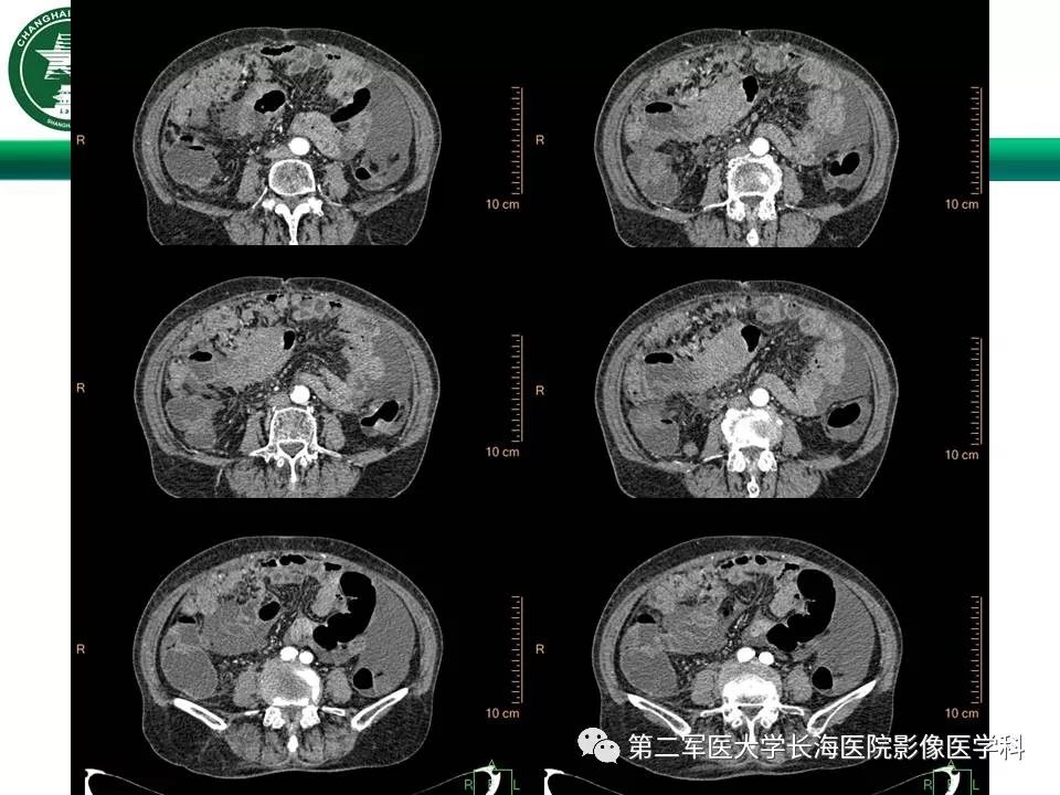 【PPT】CT结肠造影的临床应用
