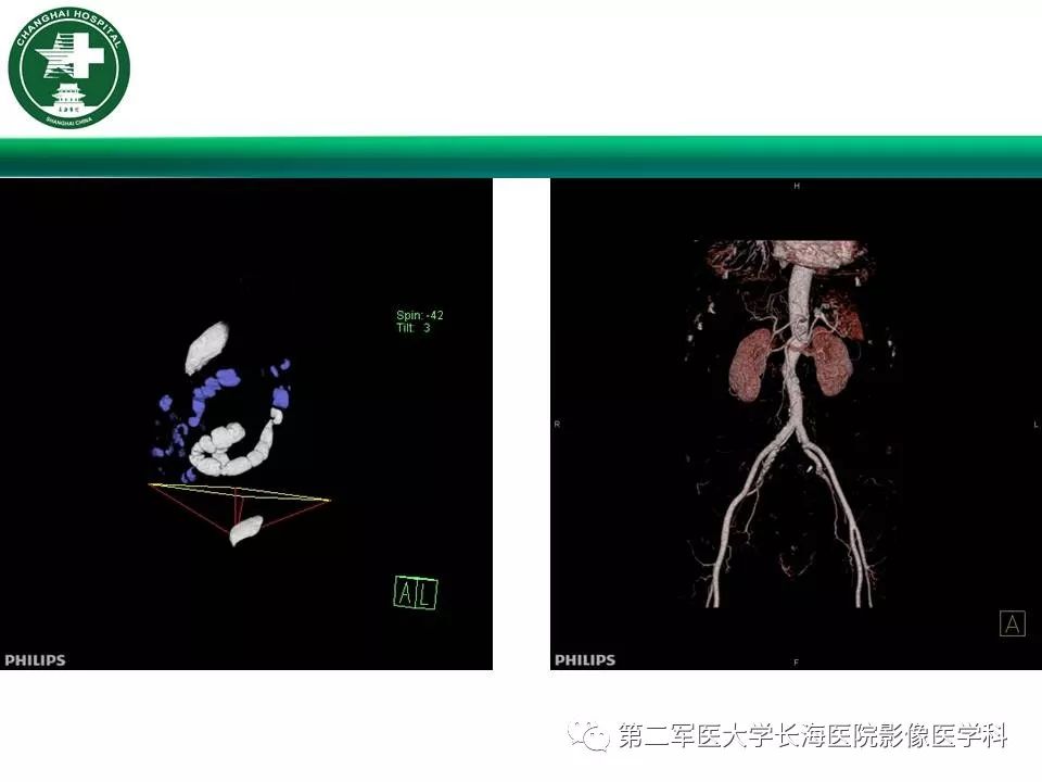 【PPT】CT结肠造影的临床应用