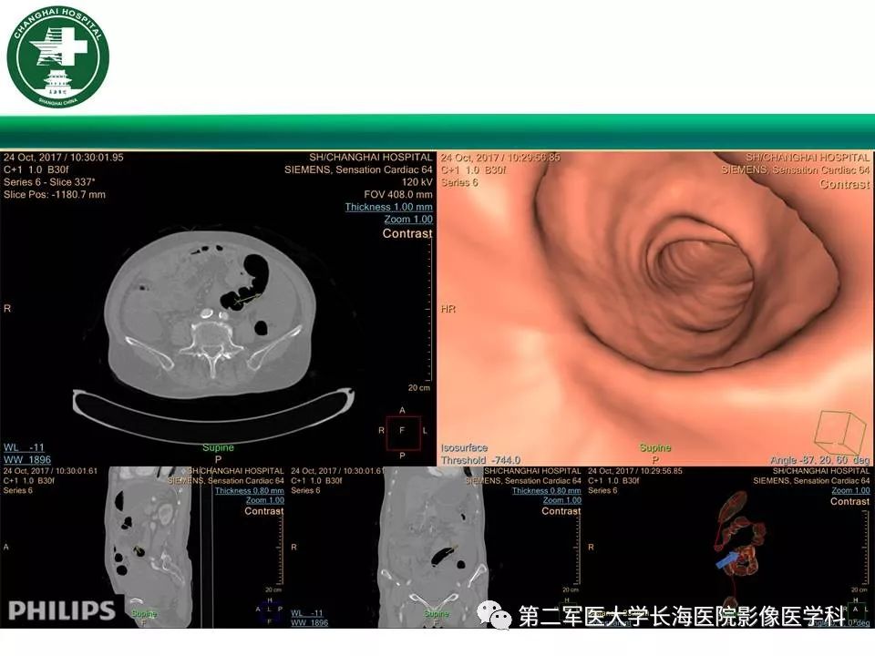 【PPT】CT结肠造影的临床应用