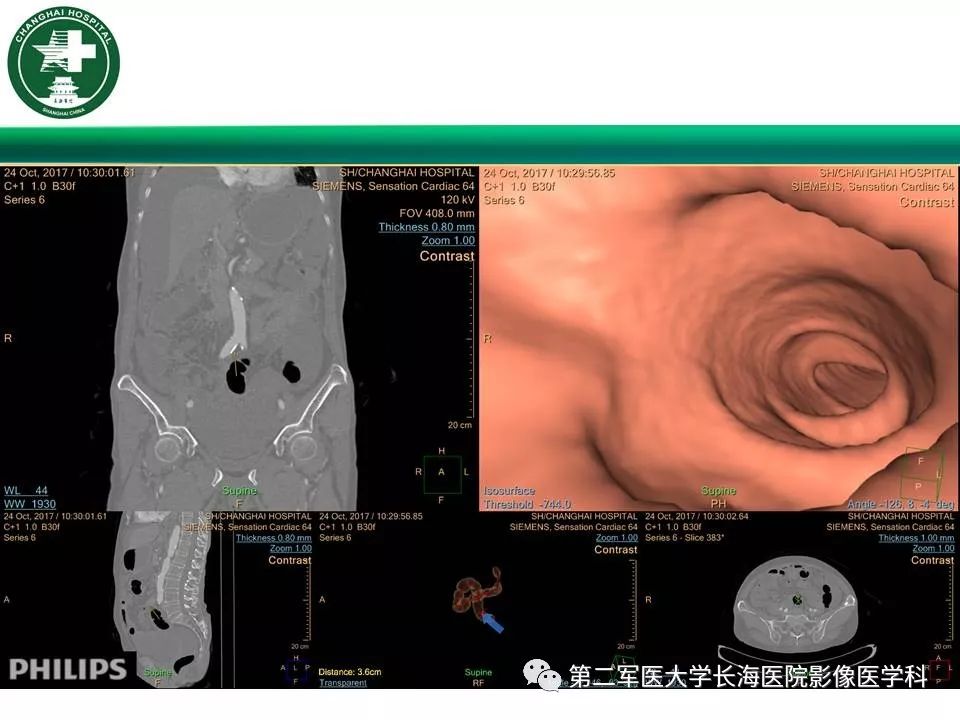 【PPT】CT结肠造影的临床应用