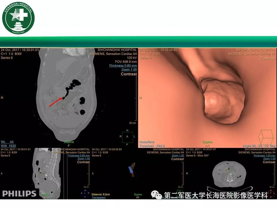 【PPT】CT结肠造影的临床应用