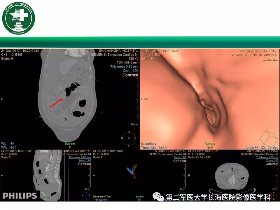 【PPT】CT结肠造影的临床应用