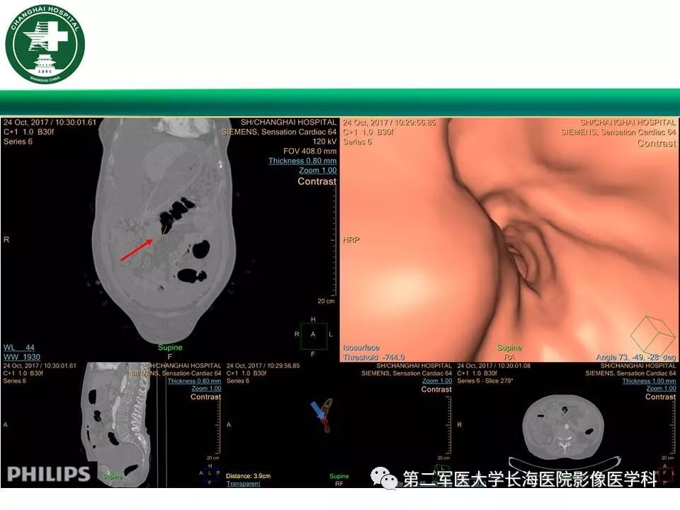 【PPT】CT结肠造影的临床应用