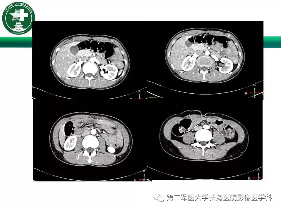 【PPT】CT结肠造影的临床应用