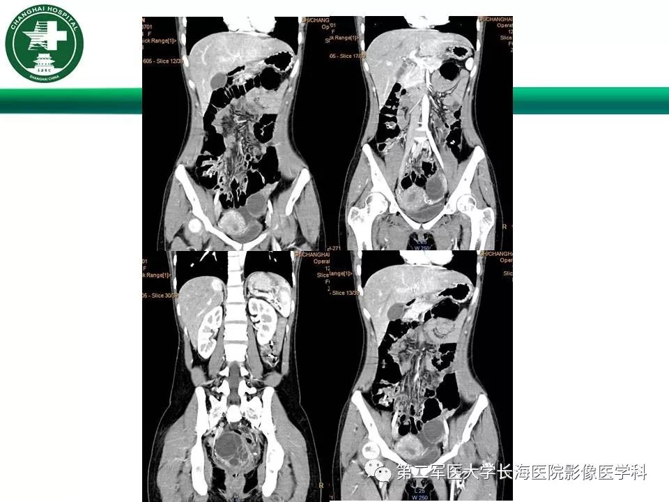 【PPT】CT结肠造影的临床应用