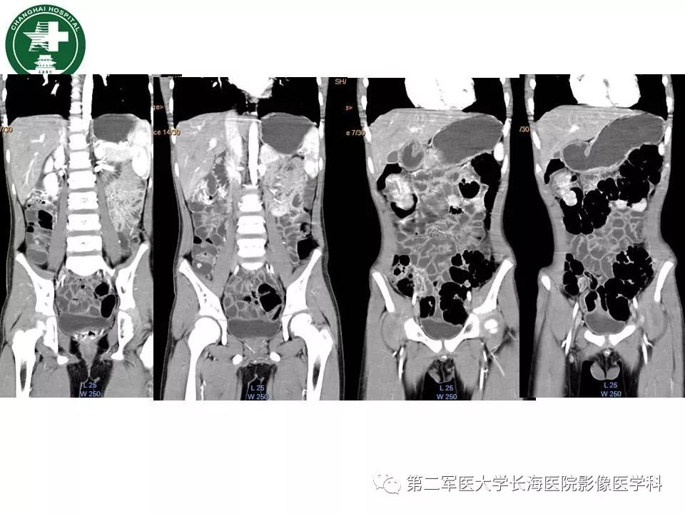 【PPT】CT结肠造影的临床应用