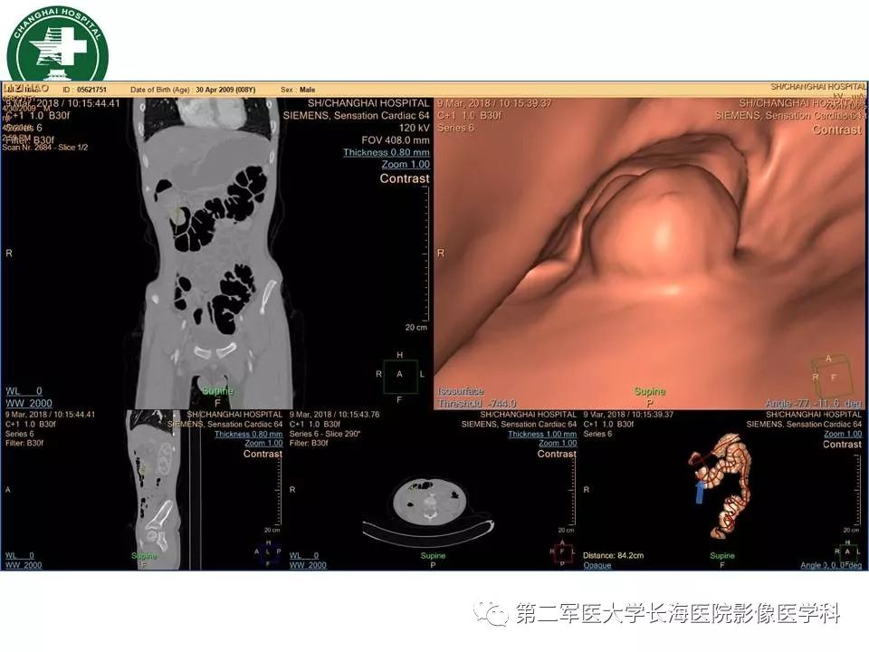 【PPT】CT结肠造影的临床应用