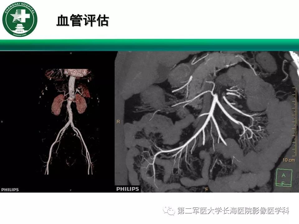 【PPT】CT结肠造影的临床应用