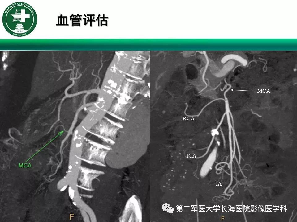 【PPT】CT结肠造影的临床应用