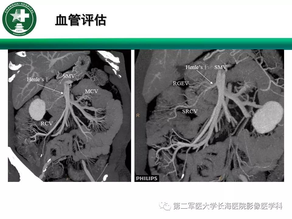 【PPT】CT结肠造影的临床应用