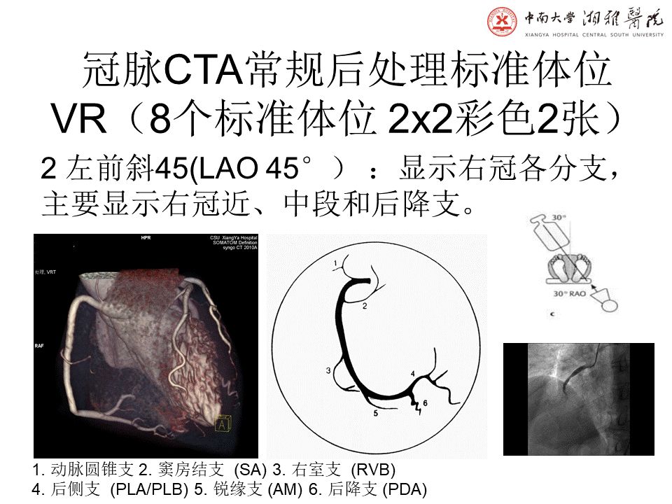 【PPT】湘雅冠脉CTA标准化后处理及规范化报告