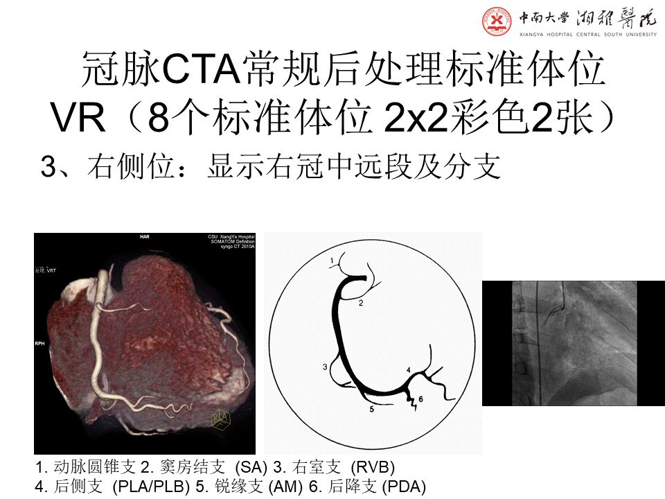 【PPT】湘雅冠脉CTA标准化后处理及规范化报告