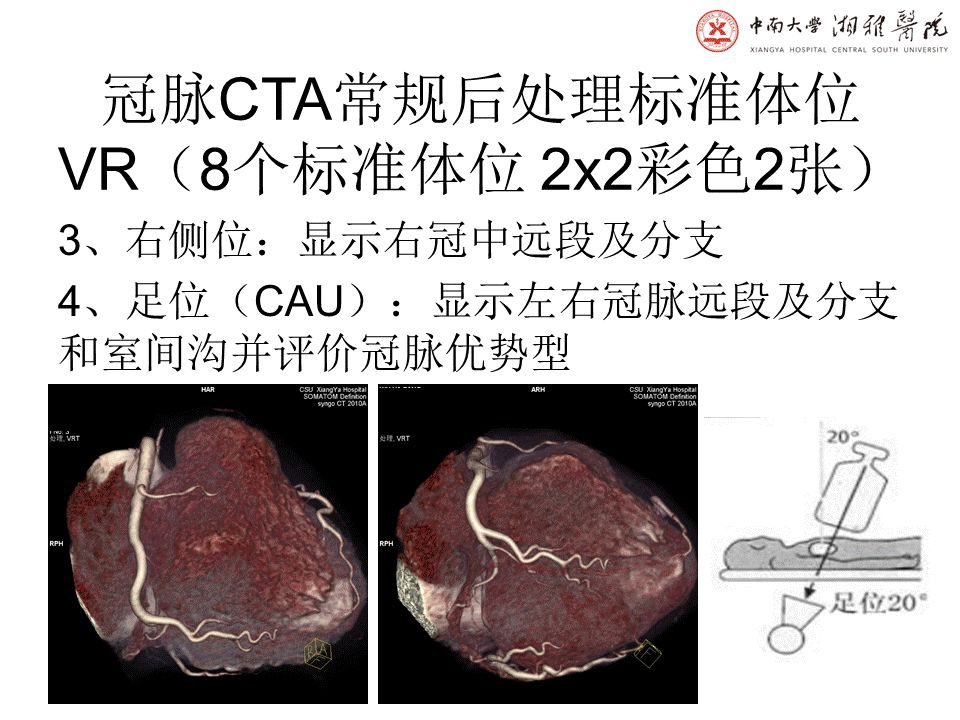 【PPT】湘雅冠脉CTA标准化后处理及规范化报告