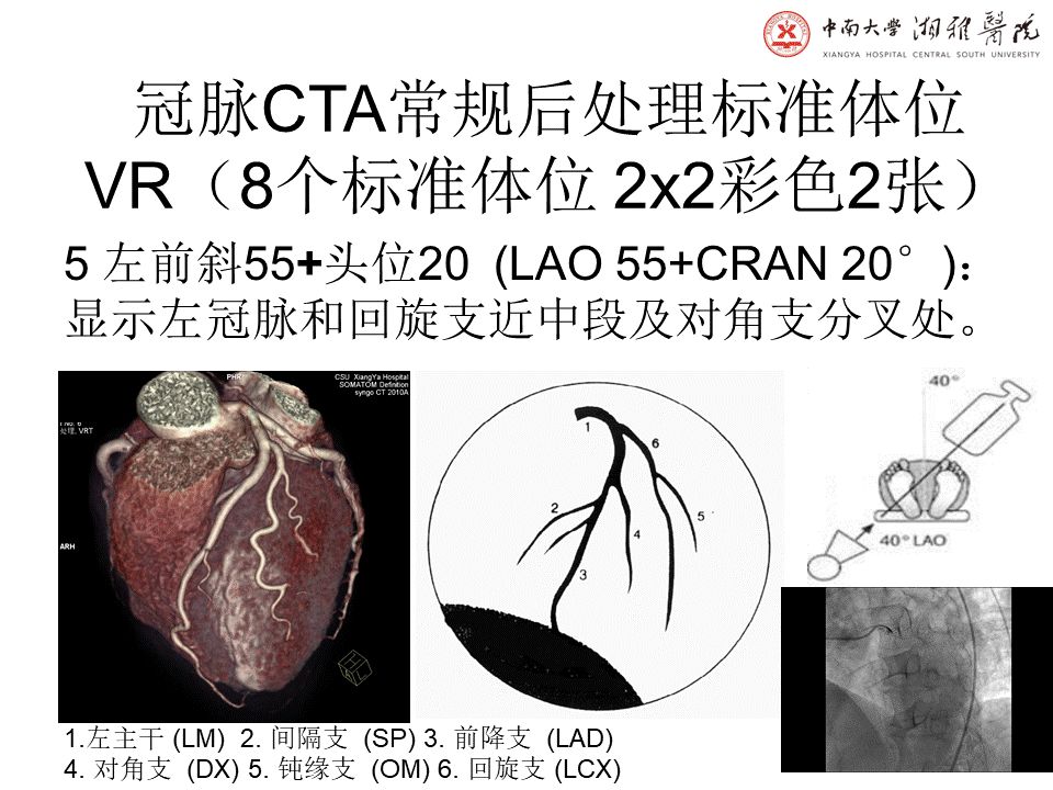 【PPT】湘雅冠脉CTA标准化后处理及规范化报告