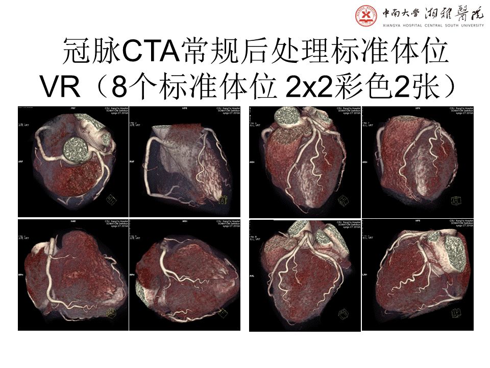 【PPT】湘雅冠脉CTA标准化后处理及规范化报告