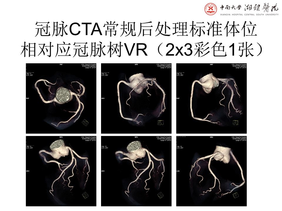 【PPT】湘雅冠脉CTA标准化后处理及规范化报告