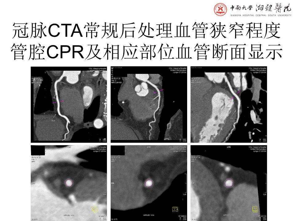 【PPT】湘雅冠脉CTA标准化后处理及规范化报告