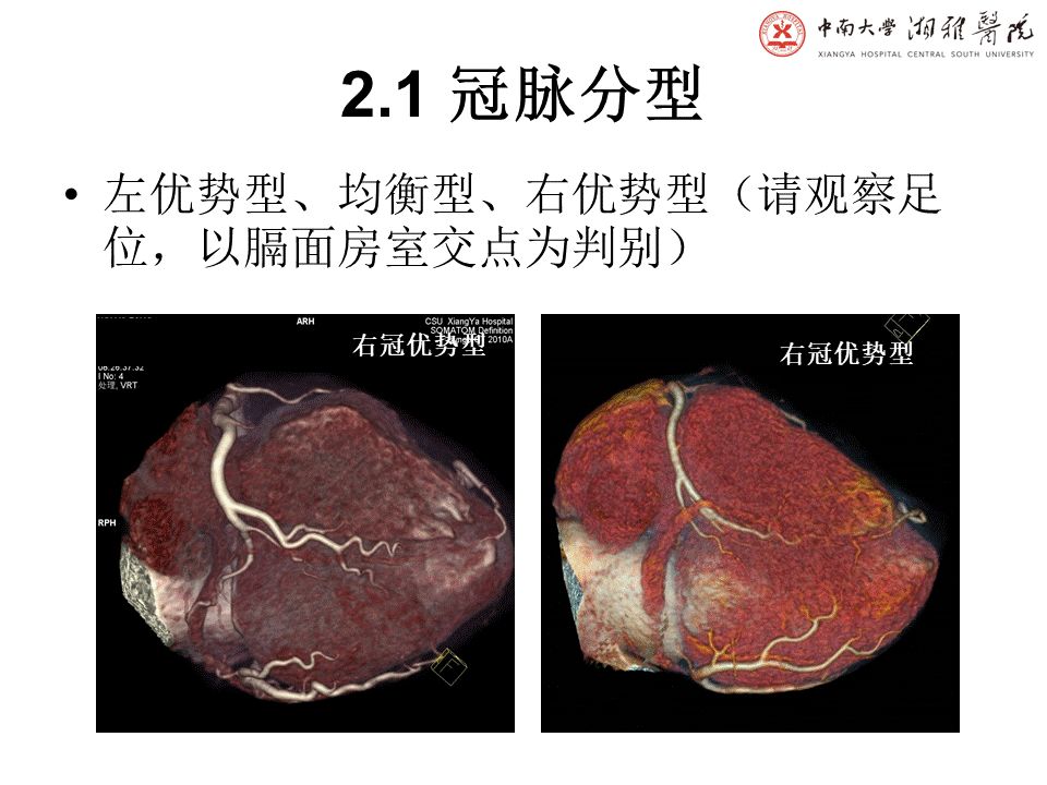 【PPT】湘雅冠脉CTA标准化后处理及规范化报告