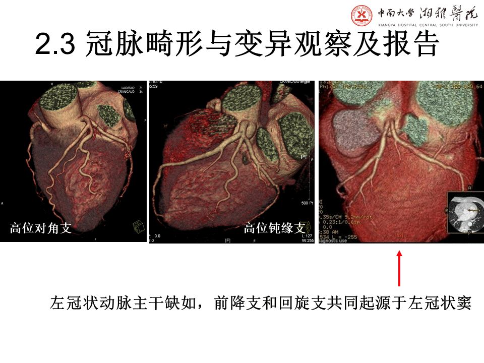 【PPT】湘雅冠脉CTA标准化后处理及规范化报告