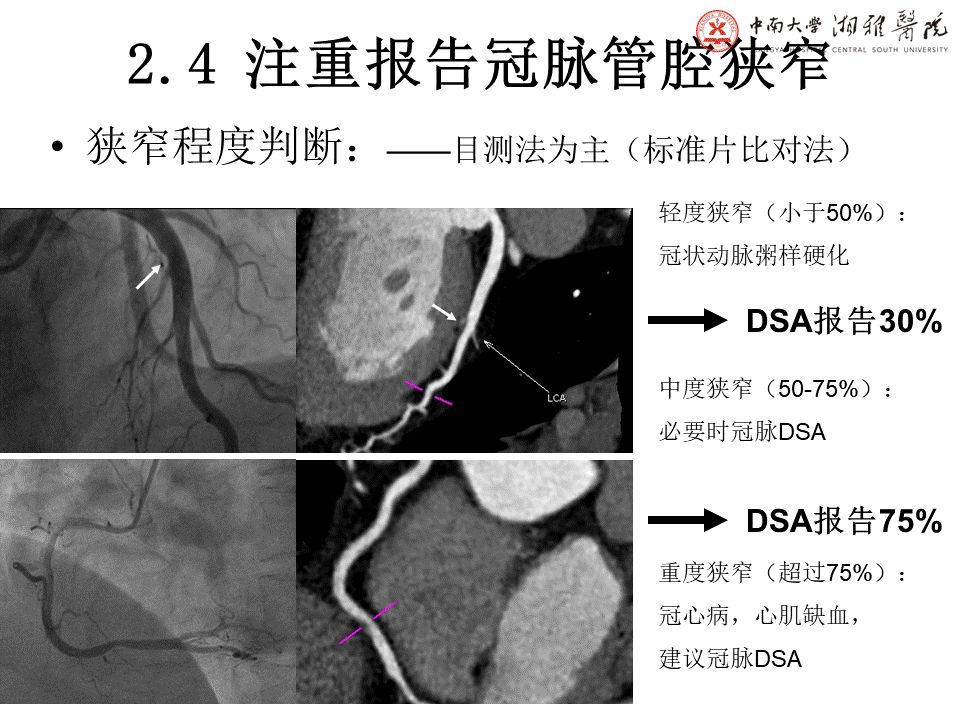 【PPT】湘雅冠脉CTA标准化后处理及规范化报告