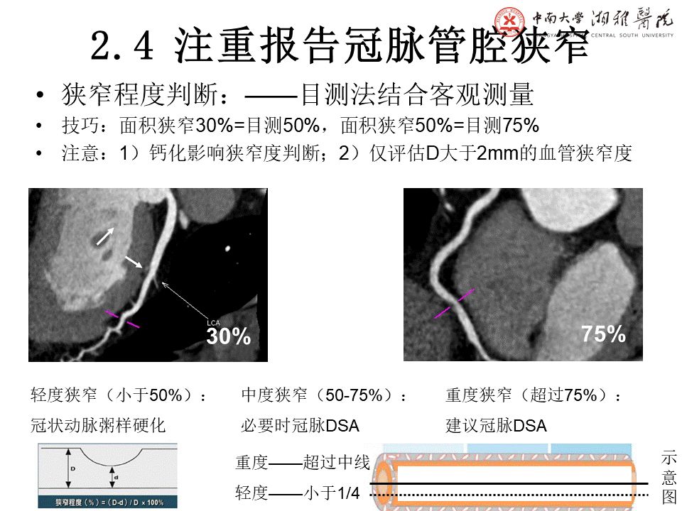 【PPT】湘雅冠脉CTA标准化后处理及规范化报告