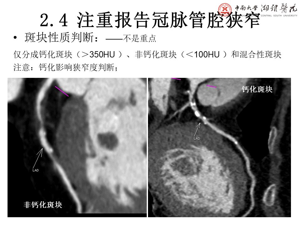 【PPT】湘雅冠脉CTA标准化后处理及规范化报告