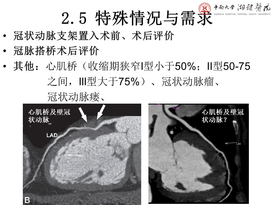 【PPT】湘雅冠脉CTA标准化后处理及规范化报告