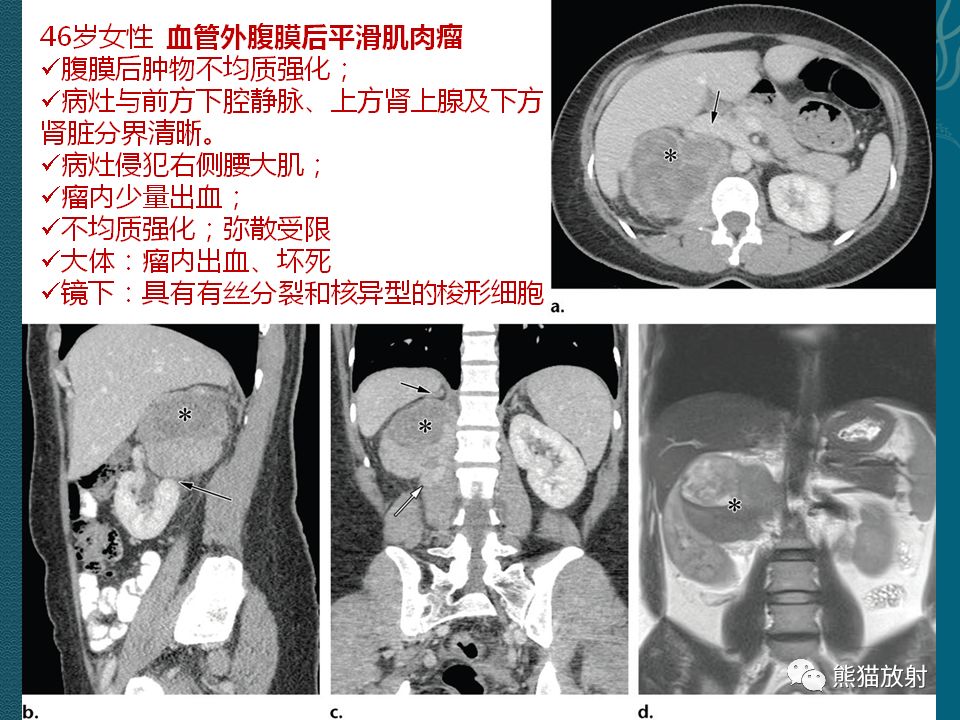 【PPT】腹膜后平滑肌肉瘤诊断及鉴别诊断