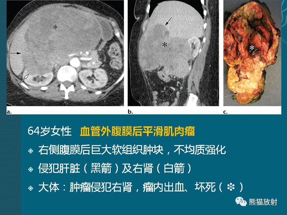 【PPT】腹膜后平滑肌肉瘤诊断及鉴别诊断