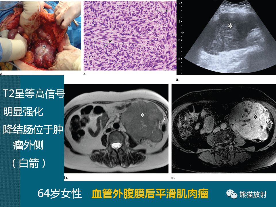 【PPT】腹膜后平滑肌肉瘤诊断及鉴别诊断