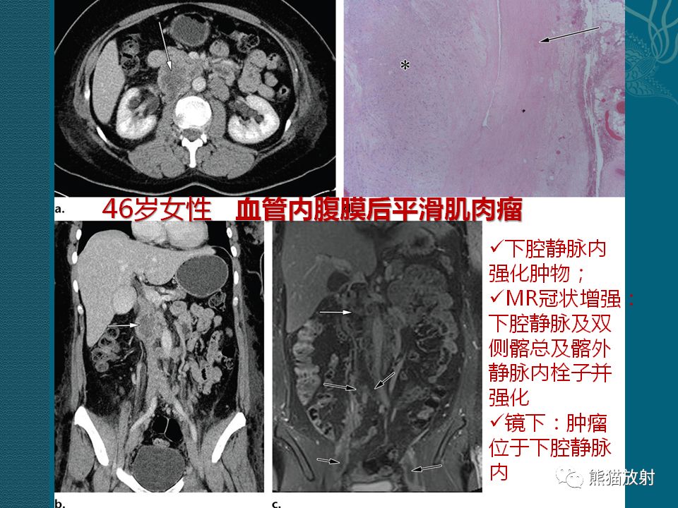 【PPT】腹膜后平滑肌肉瘤诊断及鉴别诊断