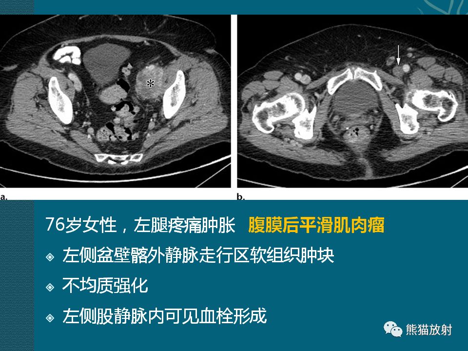 【PPT】腹膜后平滑肌肉瘤诊断及鉴别诊断