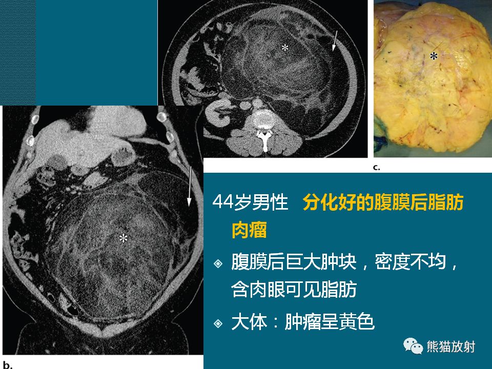 【PPT】腹膜后平滑肌肉瘤诊断及鉴别诊断
