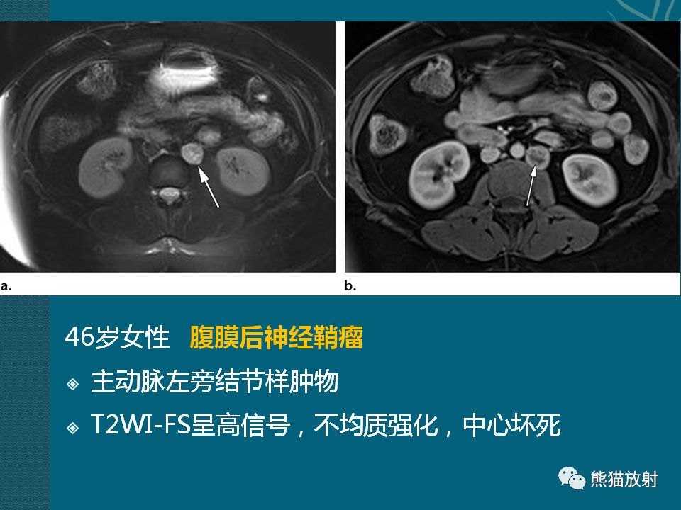 【PPT】腹膜后平滑肌肉瘤诊断及鉴别诊断
