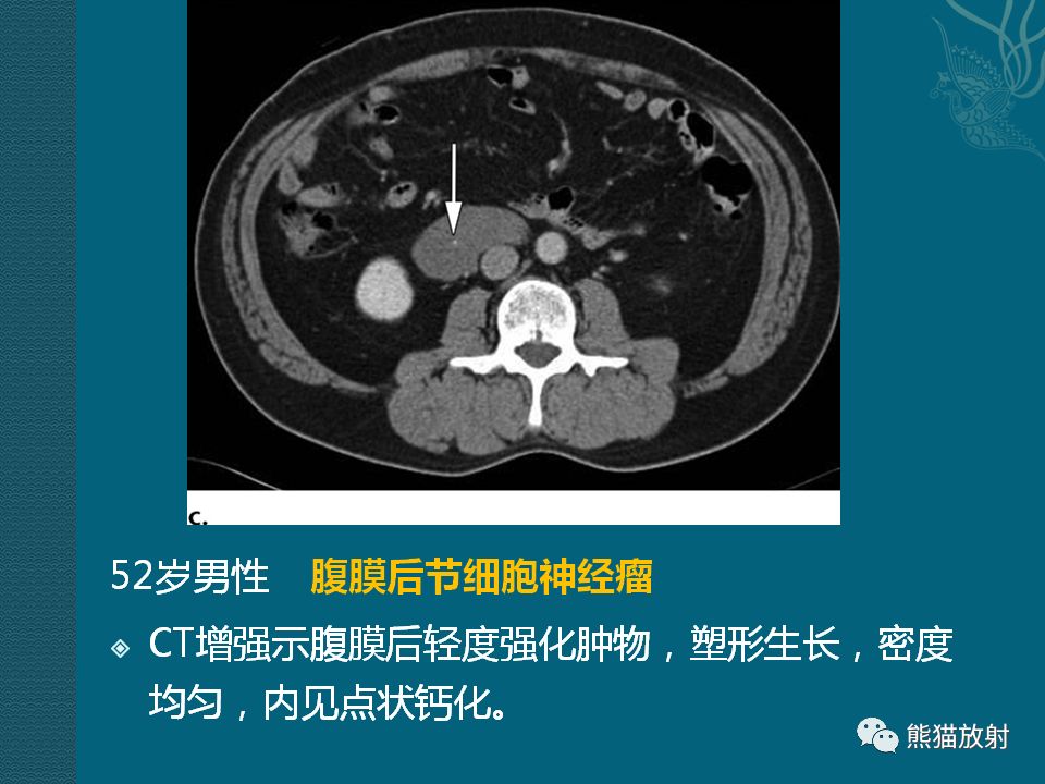 【PPT】腹膜后平滑肌肉瘤诊断及鉴别诊断