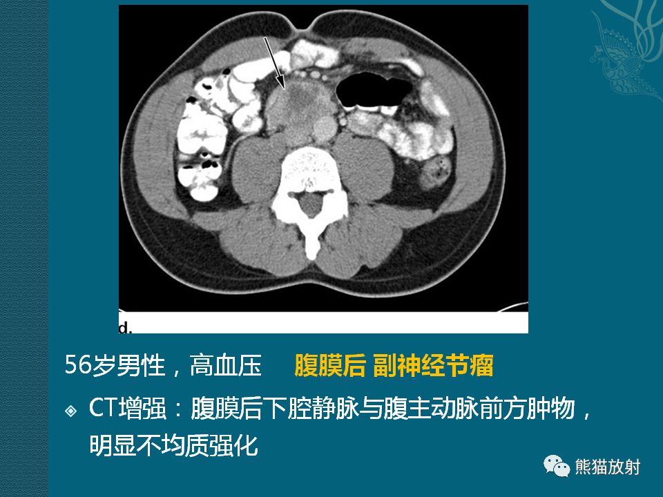 【PPT】腹膜后平滑肌肉瘤诊断及鉴别诊断