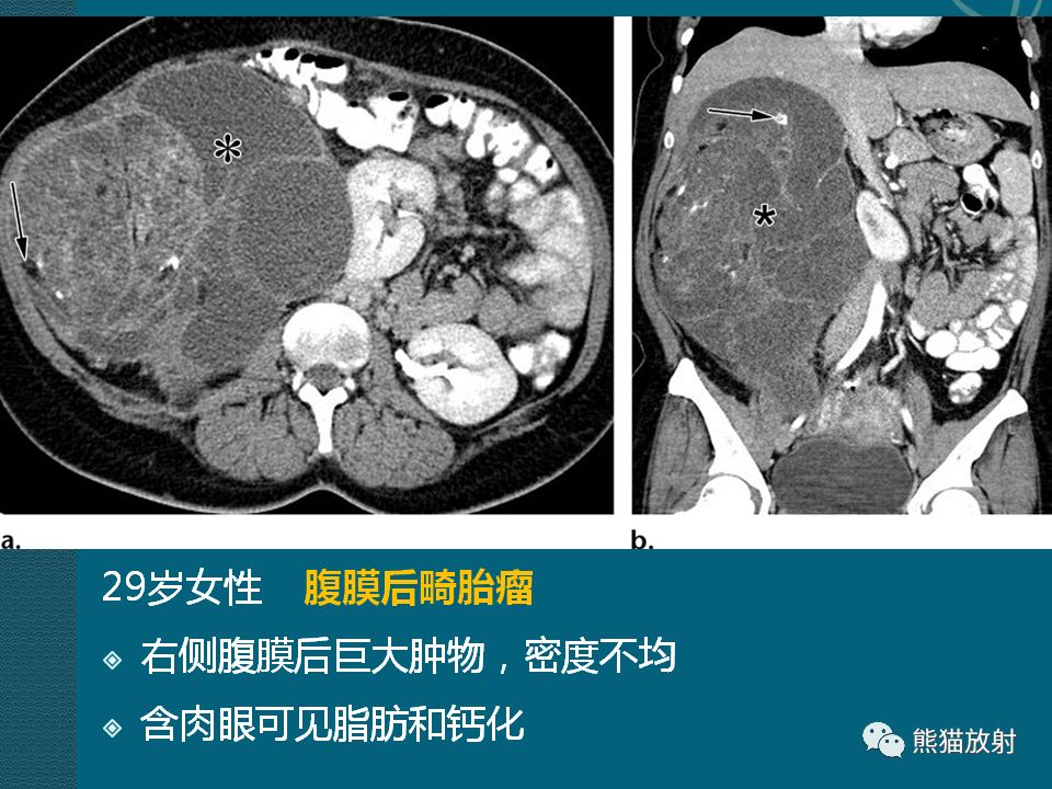 【PPT】腹膜后平滑肌肉瘤诊断及鉴别诊断