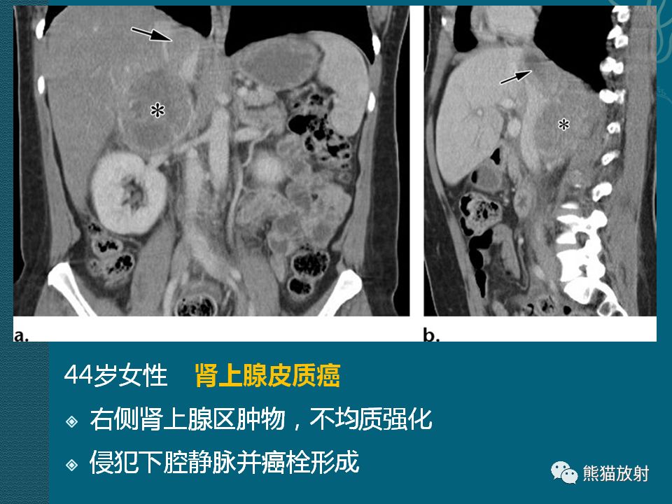 【PPT】腹膜后平滑肌肉瘤诊断及鉴别诊断