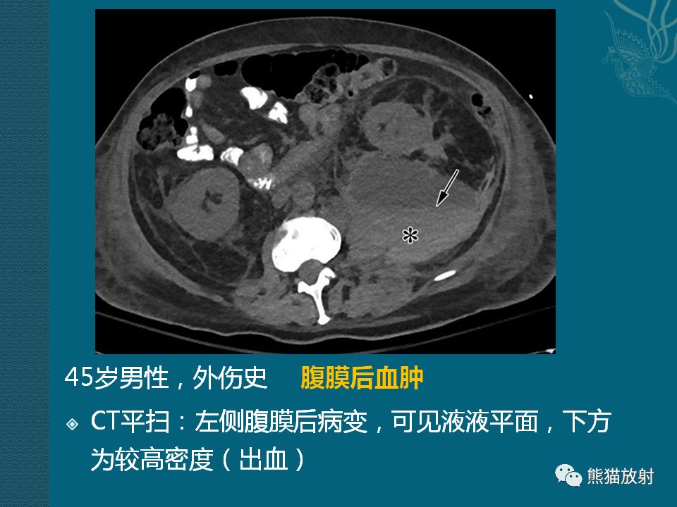 【PPT】腹膜后平滑肌肉瘤诊断及鉴别诊断