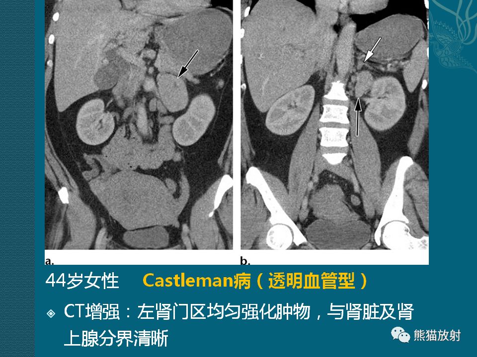 【PPT】腹膜后平滑肌肉瘤诊断及鉴别诊断